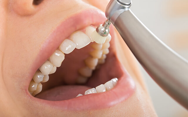 機械的歯面清掃（PMTC）